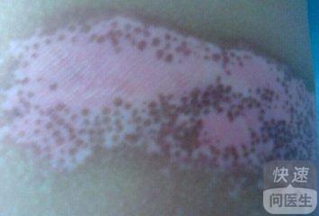1歲多的孩子患上白癜風怎么治 小兒白癜風治法介紹
