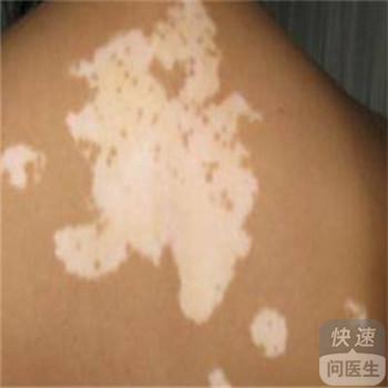 白癜風病的治療費用是多少，介紹幾個治療白癜風的常見誤區