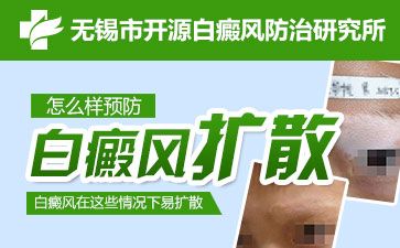 無錫白殿瘋專科醫院介紹兒童白斑的最佳治療方法是什么