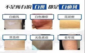 白癜風醫生郭廣英詳談白癜風健身的五大誤區