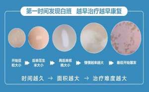 白癜風醫生袁仁軍解讀白癜風患者應注意的事項
